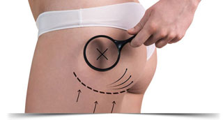Cirugia Gluteos